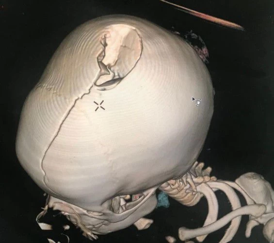 فريق طبي ينجح بترميم كسر جمجمة طفلة في وادي الدواسر