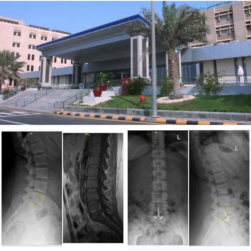 مستشفى الملك فهد الجامعي بالخبر ينجح في تغيير لغضروف الفقرات القطنية عن طريق البطن
