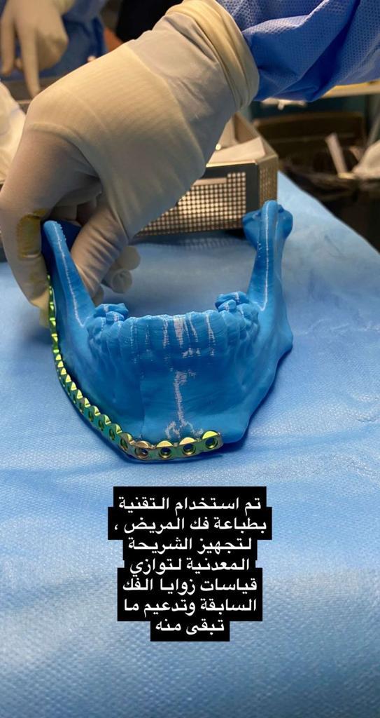"تخصصي تبوك" يتمكن من إعادة بناء فك مريض
