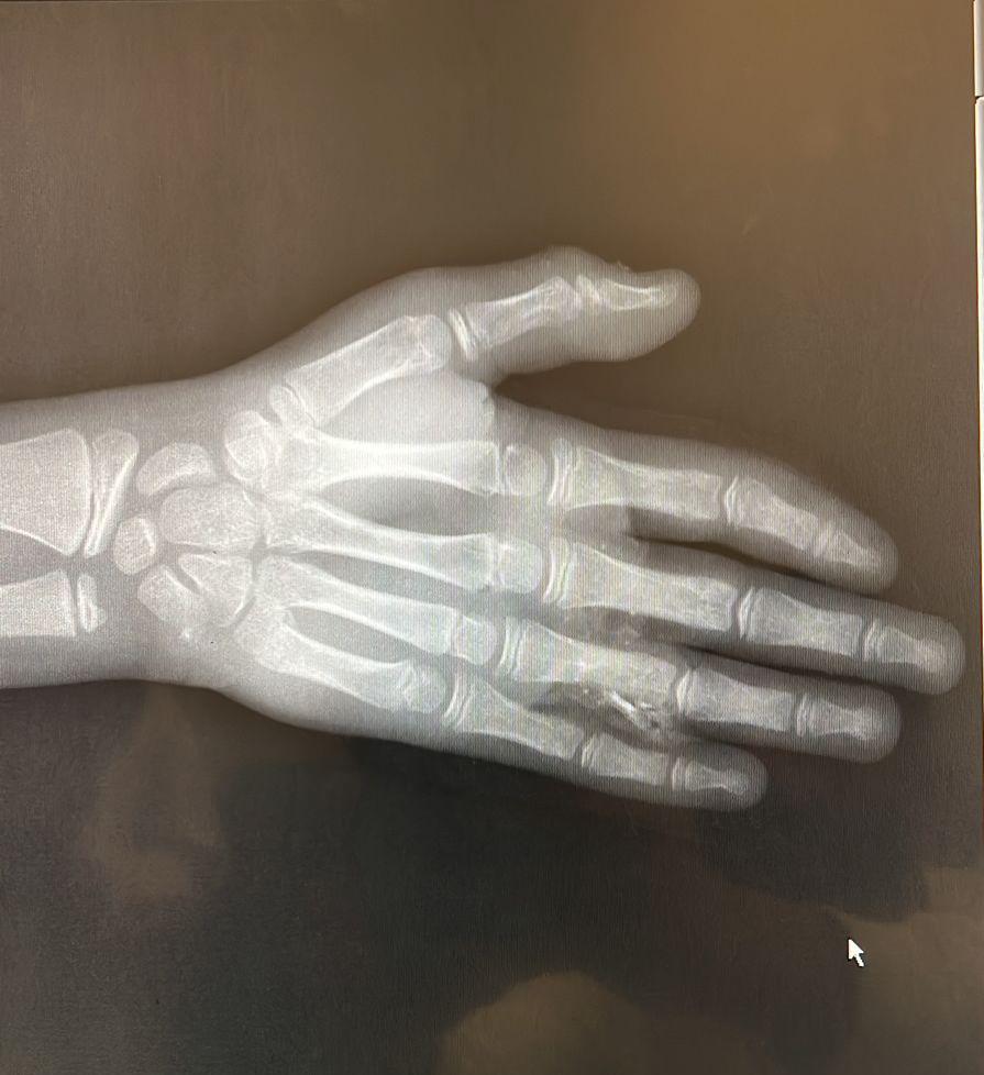 تدخل طبي ناجح بمستشفى الحريق لطفل تعرض لحادث مروري