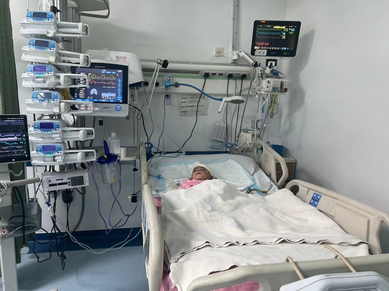جراحة عاجلة لإيقاف نزيف بجمجمة رضيع في الجوف 