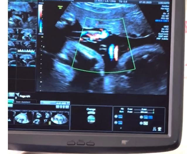 جراحة "علاج الأجنّة" داخل الرحم.. ولادة آمنة وتقليل من الوفيات 35  حالة نقل دم للأجنة