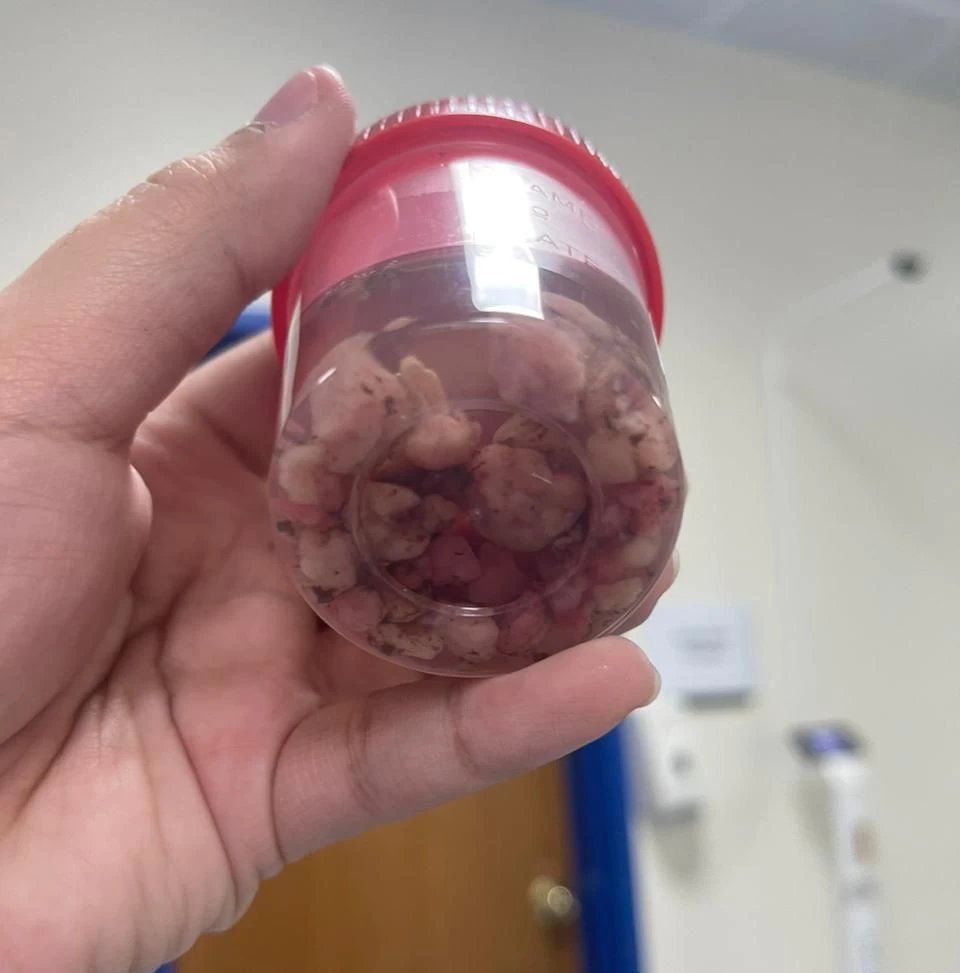 مستشفى الملك سلمان يستأصل 21 لحمية كبيرة الحجم من معدة مريض