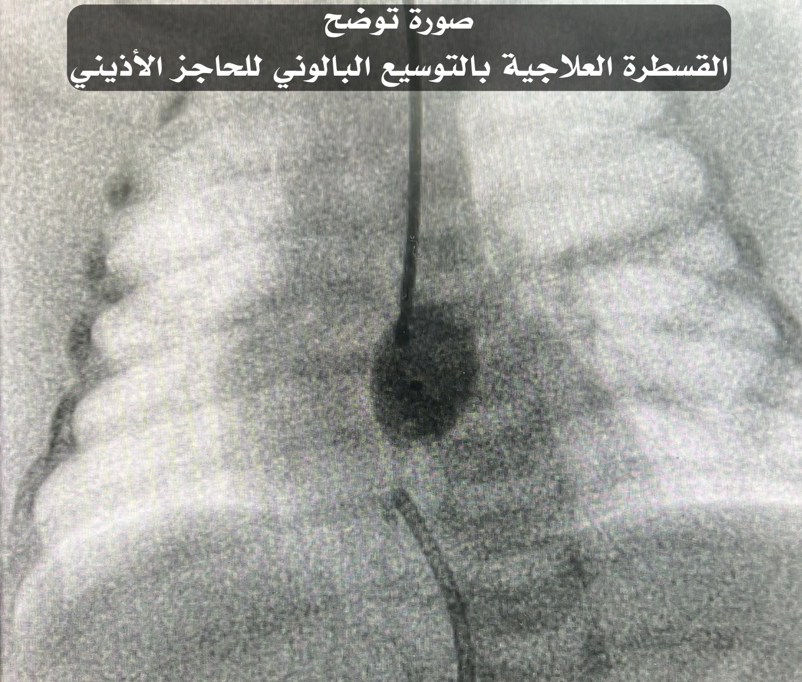 مركز الأمير سلطان لطب وجراحة القلب يُنقذ حياة طفلة تبلغ من العمر يوم