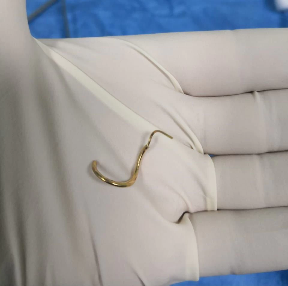 إزالة " حلق" من مريء طفلة بعمر 3 أعوام في مستشفى الملك سعود بعنيزة