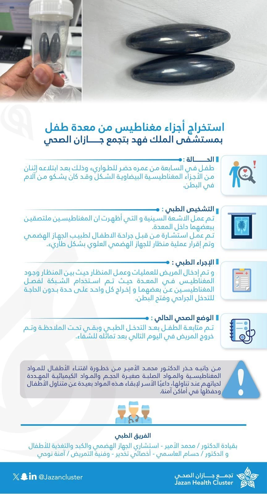 فريق طبي بمركزي جازان يستخرج زوجاً مغناطيسياً من أمعاء طفل دون الحاجة لتدخل جراحي