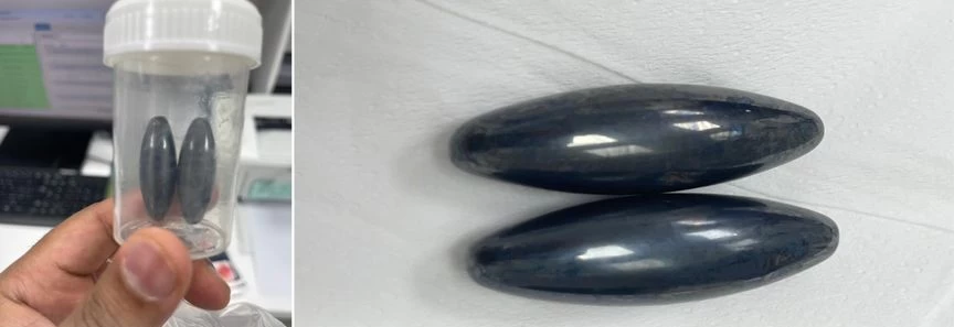 إنجاز طبي استثنائي في جازان: استخراج مغناطيس من أمعاء طفل بدون جراحة!