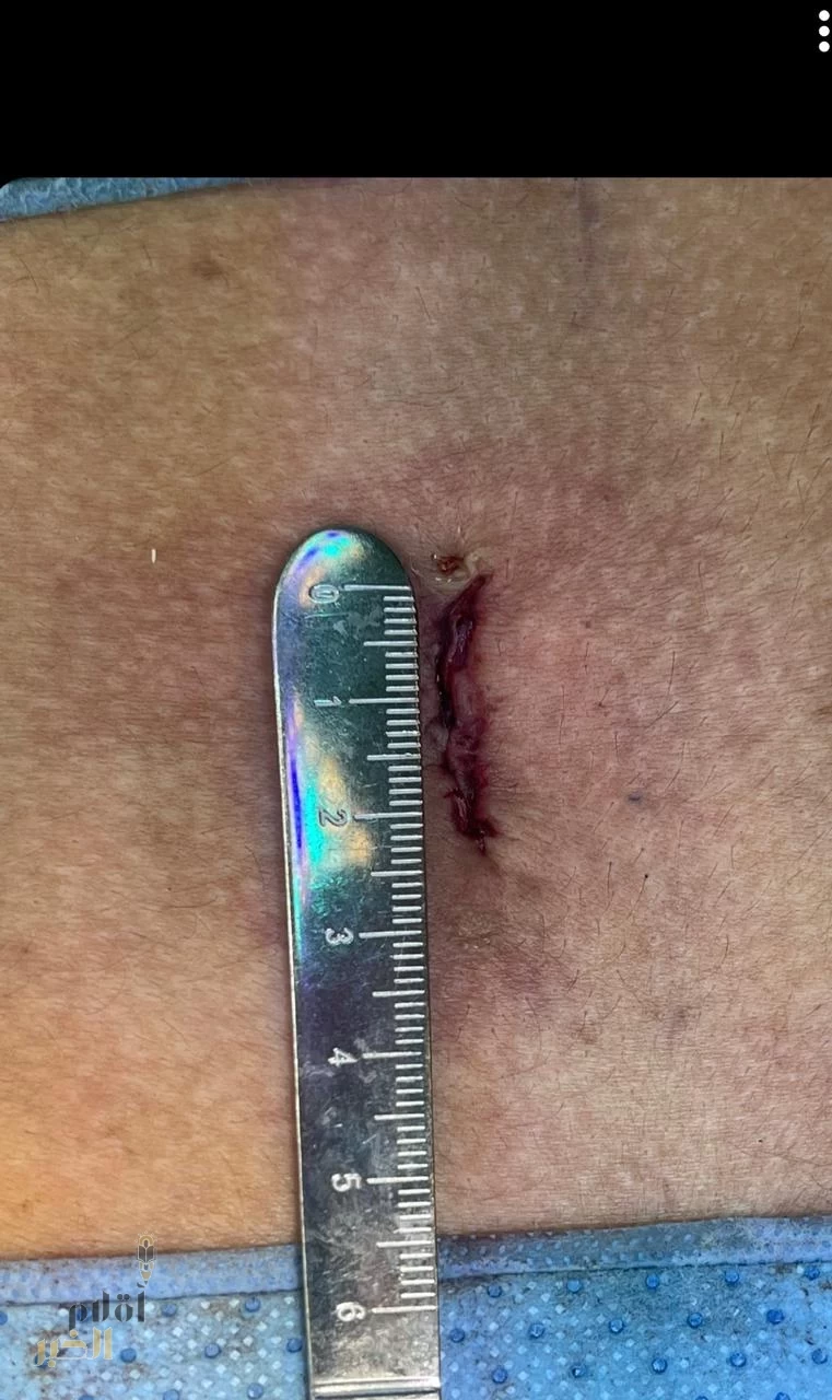 نجاح عملية جراحية صعبة بمجمع الملك عبدالله الطبي بجدة