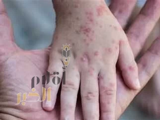 الاتحاد الأوروبي يحذّر من السفر مع تزايد مخاطر الجدري على مستوى العالم