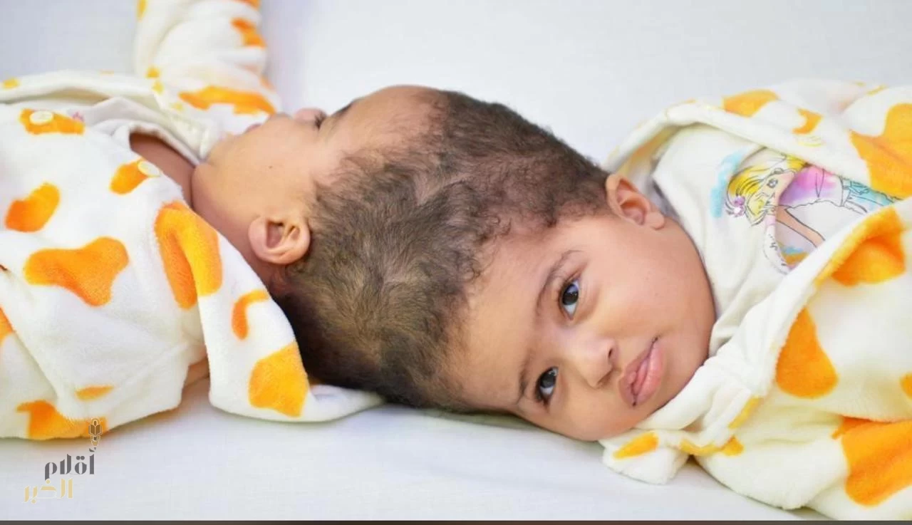 نجاح عمليّة فصل التوأم الملتصق الإريتري " أسماء وسمية " بعد عملية جراحة دقيقة استغرقت 15 ساعة ونصفاً