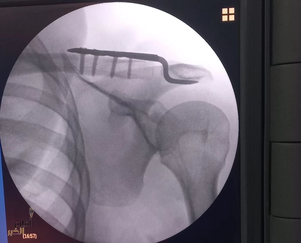 نجاح أول عملية نوعية لخلع المفصل الأخرمي الترقوي بمستشفى القويعية