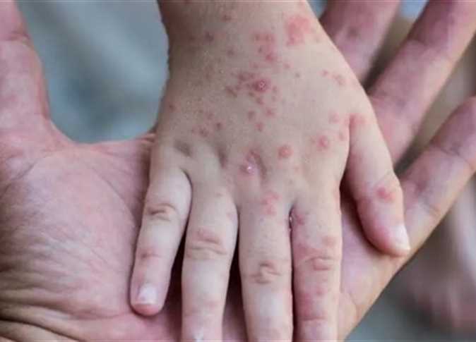 الصحة ترفع جاهزية منشاتها الصحية ،، وتؤكد عدم تسجيل أي حالة مصابة بجدري القردة في المملكة