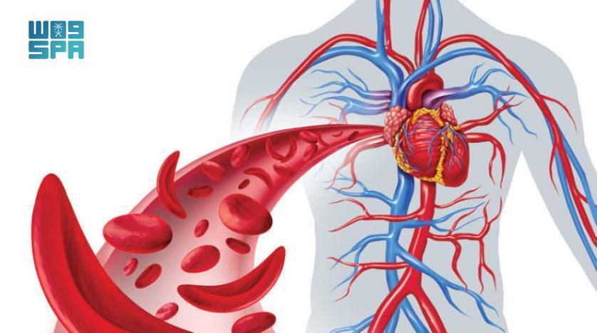 اليوم العالمي لأنيميا الخلايا المنجلية.. برامج توعوية وتثقيف مستمر