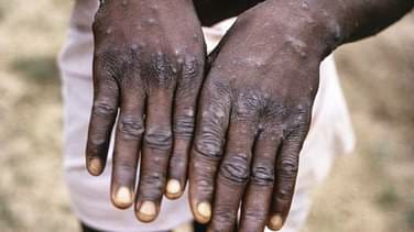 فيروس قاتل "  ....الصحة العالمية تحذر من جدري القردة