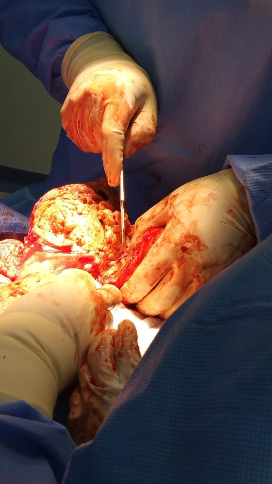 استئصال ورم ليفي كبير من سيدة سعودية تبلغ 20 عام مع الحفاظ على الرحم