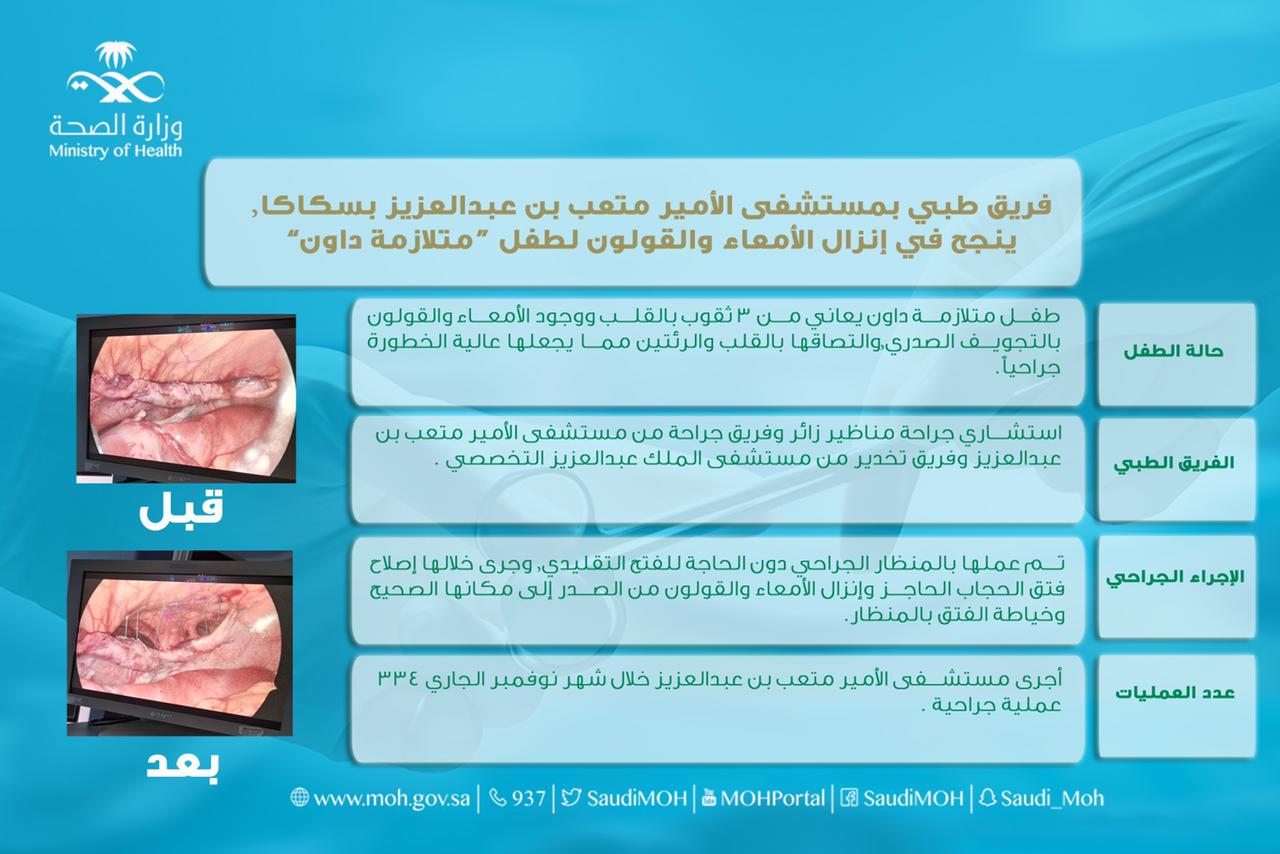 فريق طبي بمستشفى الأمير متعب بن عبدالعزيز بسكاكا, ينجح في إنزال الأمعاء والقولون لطفل “متلازمة داون”