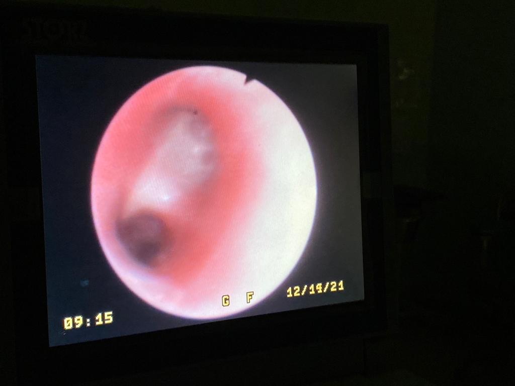 نجاح عملية تنظير للقصبة الهوائية لطفلة